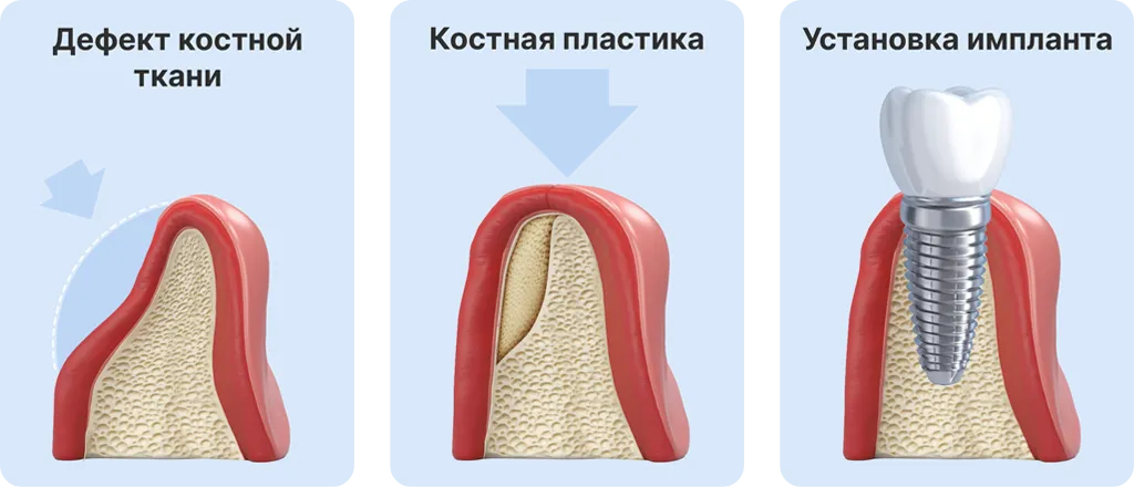 Костная пластика и синус-лифтинг